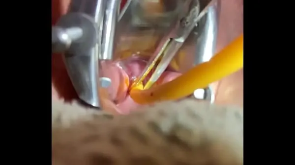 Žhavé filmy na disku Inserting Foley into cervix