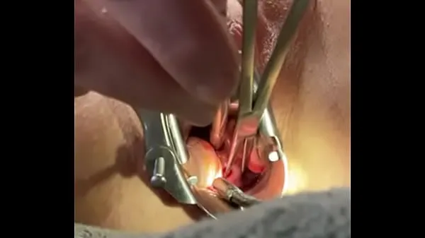 Hot Holding cervix w tenaculum while 8mm dilator fucks uterus drive Movies