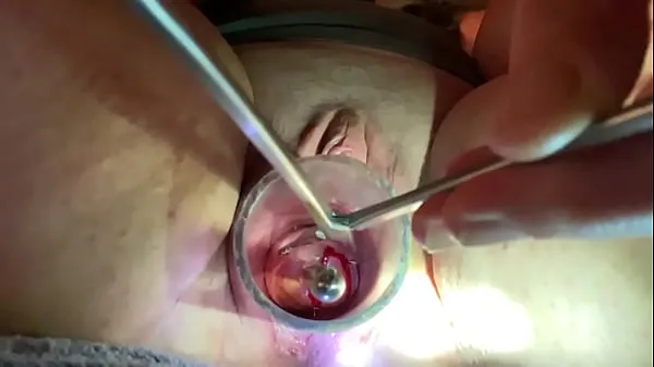 Hot Dilating to 9mm w Tenaculum and Hegar drive Movies